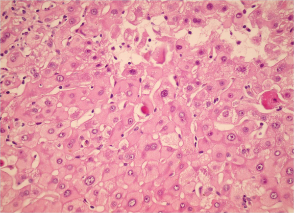 Sections From Liver Needle Biopsy in a Recurrent Chronic Hepatitis B Shows Ground Glass Hepatocytes (H&E X250)