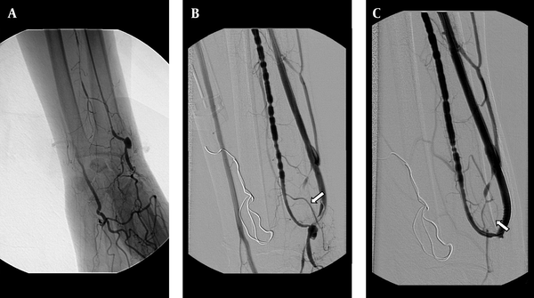 A 48-year-old man with radiocephalic fistula in the left forearm. A, Retrograde catheterization failed to canalize obliterated outflow vein. The fistulogram obtained with the antegrade approach throughout the brachial artery shows the occlusion of the fistula. B, After balloon dilatation (3.5 mm) of the obliterated segment, the dilatation was complicated by dissection at the venous side of the fistula (arrow). C, The 4×23 mm sized stent was placed at the dissected segment and the control fistulogram showed the patency of the fistula and the normal calibration of the venous segment.