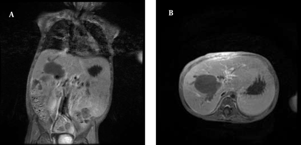 A, B: Magnetic Resonance Imaging of the Abdomen Shows Multiple Low-Signal Masses in the Liver Associated With Biliary Dilatation