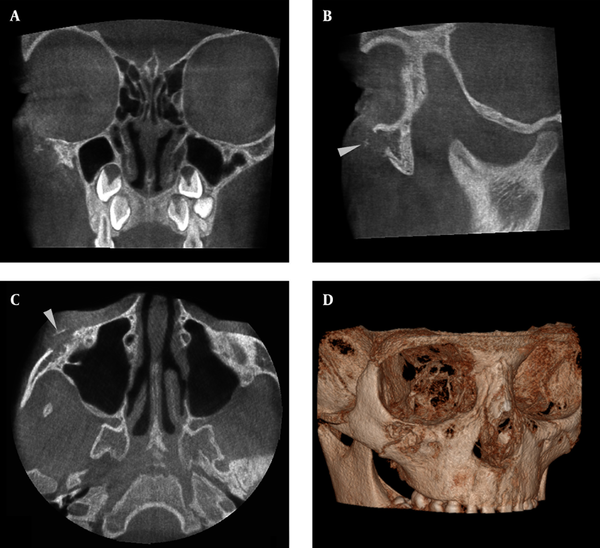 A, Coronal; B, Sagittal; C, Axial and D, 3D views of cone beam computed tomography demonstrate a lytic lesion in the right infraorbital rim and zygomatic buttress. note the presence of a coarse straight septum (arrowhead).