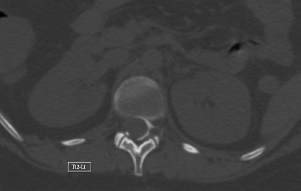 Transverse CT Slice of the Spine Showing Asymmetrical Left-Right Spread of Contrast Material