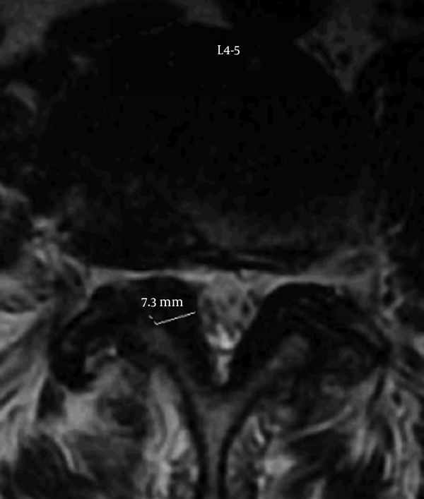 MRI Axial View of Lumbar Spine at L4-5