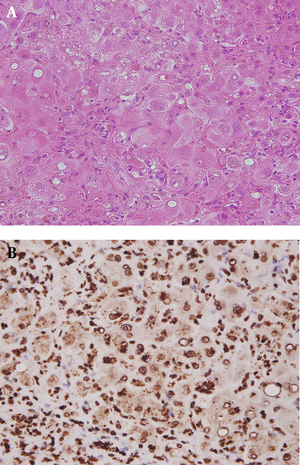 A) Hepatitis Characterized by Ballooning Change of Hepatocytes with Marked Lymphocyte Infiltration and Some Hemosiderin Deposition In addition, focal fatty changes and cytopathic effects are noted. B) Most of the lymphocytes in the liver parenchyma are immunoreactive to Epstein-Barr virus latent membrane protein 1.