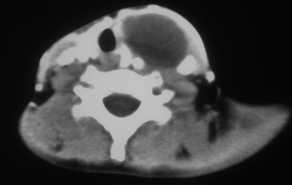 Cervical CT Scan: A Cystic Mass in the Left Lateral of the Neck