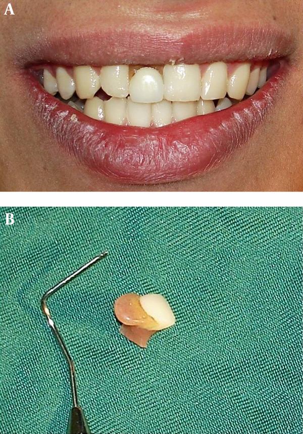 A, Clinical view of smile. B, Mobile prosthesis view.