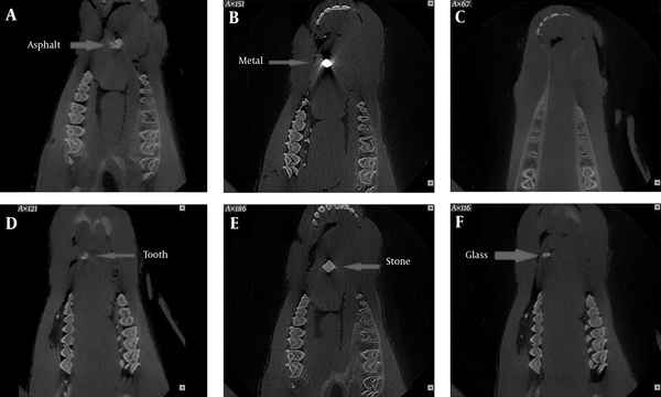 Cone beam computed tomography (CBCT) scans of foreign bodies in the tongue. A, Asphalt; B, Metal; C, Wood; D, Tooth; E,Stone; F, Glass