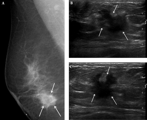 A 46-year-old woman complained of a palpable mass in her right breast. A, Right mediolateral oblique view on mammography showed an ill-defined marginated mass (arrows) on the BB marker site in the right lower area. B, Transverse and C, Longitudinal ultrasound revealed a hypoechoic mass with an irregular shape and a spiculated margin (arrows); we categorized it as BI-RADS category 5. US-CNB was performed, and confirmed invasive ductal carcinoma. The patient underwent modified radical mastectomy, after which the mass was labeled histologic grade 2, luminal A breast cancer. US-CNB: Ultrasound-guided core needle biopsy