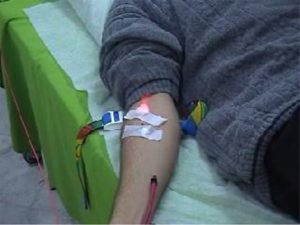 Intravenous Laser Therapy