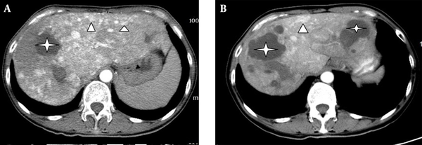 Biliary disease. A, A large biliary cyst lake in the right hepatic lobe (star) and multiple telangiectasias in the peripheral parenchyma (white arrowheads) are detected; B, An intrahepatic cystic lesion (star) is shown to be larger after 8 months without any treatment.