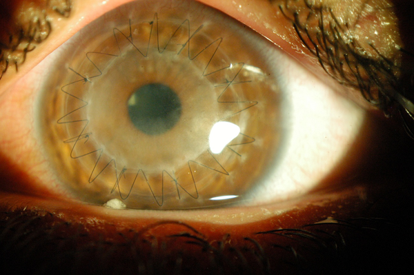 new-presentation-of-corneal-epithelial-graft-rejection-jentashapir