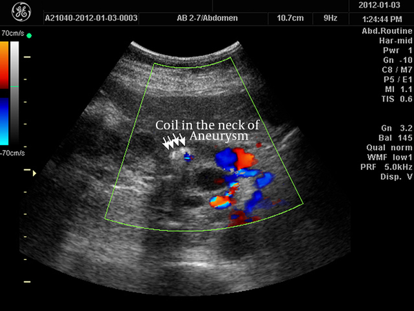 Ultrasonography two days after coil embolization shows complete thrombosis of the aneurysm.