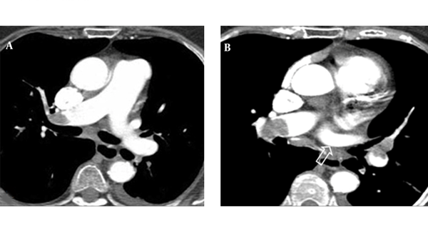 Split-bolus single-pass  64-slice CT shows a massive bilateral pulmonary embolism (A, B). Streak artifact in the superior vena cava does not affect the diagnosis of PE in the right pulmonary artery (A). Note the homogeneous enhancement of the left pulmonary vein (arrow in B).