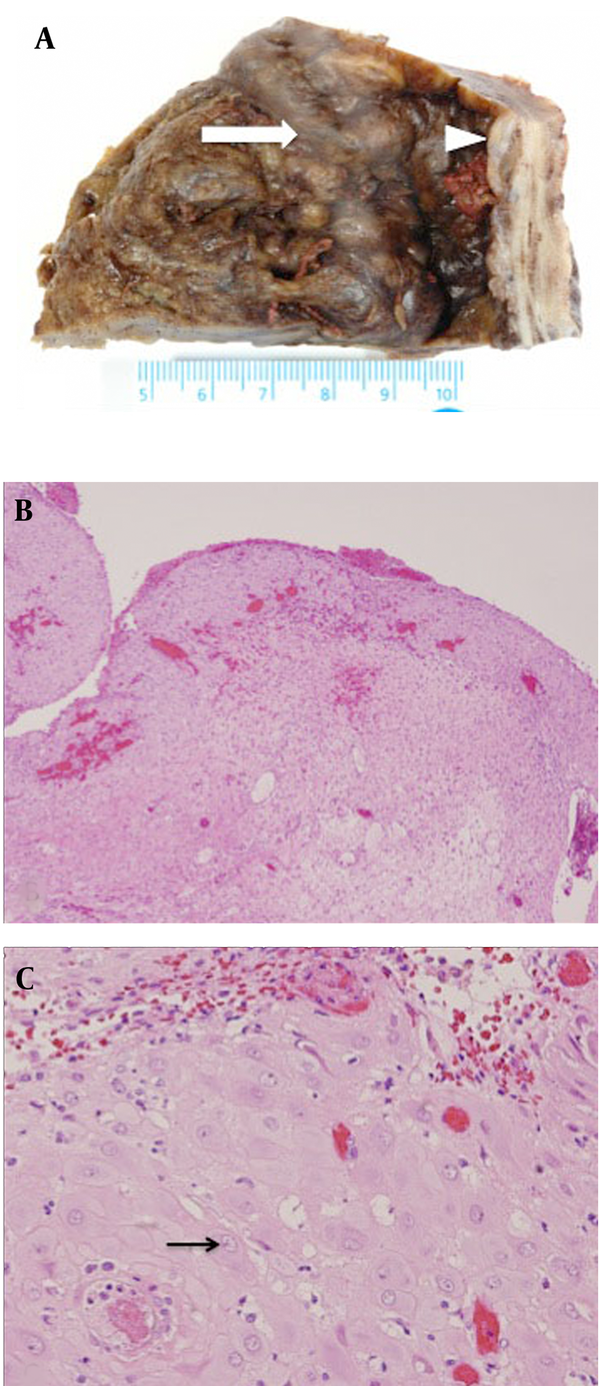 A, Photograph of the left ovarian mass shows areas of decidualized tissue (arrow) adherent to a dilated fallopian tube (arrow head). B, The low-power histological slide of the mural nodule (hematoxylin and eosin stain) shows edematous vascularized decidualized endometrial tissue with abundant cytoplasm of the stromal cells. No atypical cell was detected (hematoxylin-eosin, original magnification × 100). C, The high-power histological slide of the stromal cells shows characteristic features of decidualization, polygonal sheets and spindle shaped cells arrow with distinctive eosinophilic granular cytoplasm and round nuclei with nucleoli, embedded in an edematous myxoid background (hematoxylin-eosin, original magnification ×  200).