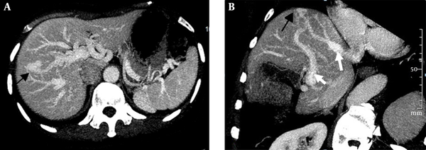 Intrahepatic portal venous shunts. A, Axial; B, Oblique maximal intensity projection images obtained in the venous phase show portal venous shunting, with the dilated portal vein (short white arrow) communicating with the hepatic vein (long white arrow) through a focal vascular mass (black arrow).