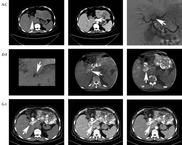 TEA With TACE in 61-Year-Old Male With Unrespectable HCC and PVTT (Vp3)