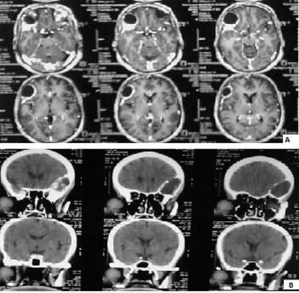 Computed Tomographic Images of the Frontal Bone Cyst Mass