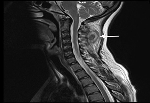 A target shaped lesion, central hypointense and peripheral mild hyperintence thick rim with surrounding edema located on the mid-line of the neck around C3 and C4 vertebrae on sagittal T2WI is seen.