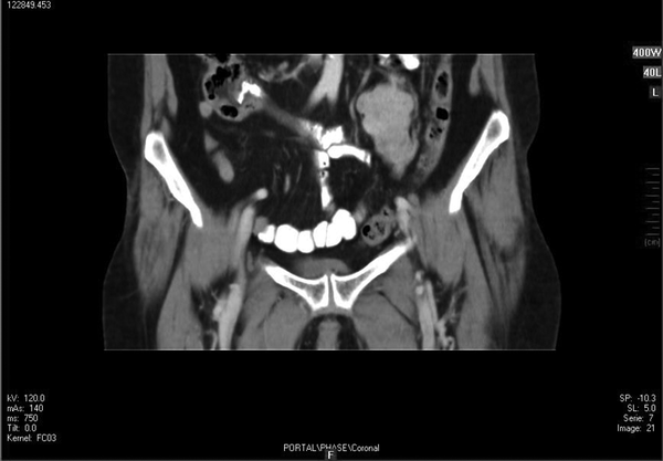 Coronal Cut of Abdominopelvic CT Scan With Oral and IV Contrast