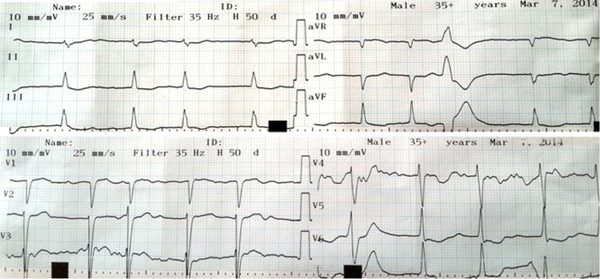 An Electrocardiography Performed Concurrent With the Patient’s Symptoms Demonstrated Atrial Fibrillation