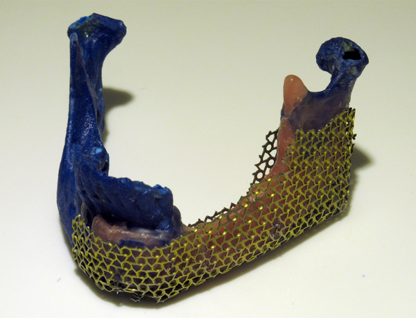 Resin Prototype With the Adapted Ti-Mesh