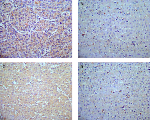 (A) High expression of HMGB1 in HCC tissue samples, HMGB1 immunostaining was predominantly localized in the cytoplasm of HCC cells (× 400). (B) Weak expression of HMGB1 protein in the para-tumor tissue samples ( ×400). (C) High expression of c-IAP2 protein in HCC tissue samples. c-IAP2 immunostaining mainly occurs in the cytoplasm of tumor cells (× 400). (D) Weak expression of c-IAP2 in para-tumor tissue samples (× 400).