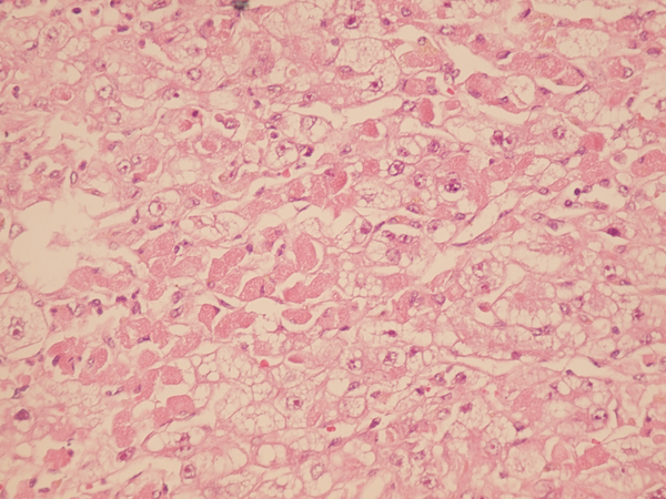 Sections From Liver Needle Biopsy Show Pericentral Ballooning Degeneration and Single Cell Apoptosis, 7 Days Post Transplantation (H&E X250)
