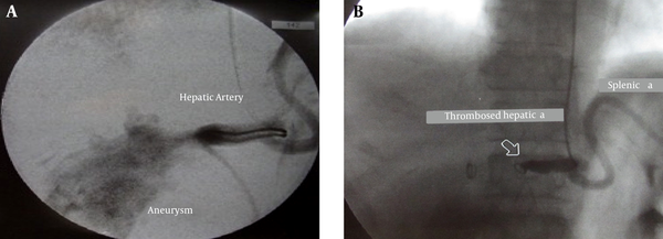 The digital subtraction angiogram of hepatic artery aneurysm before (A) and after (B) coil embolization shows complete thrombosis of the aneurysm.