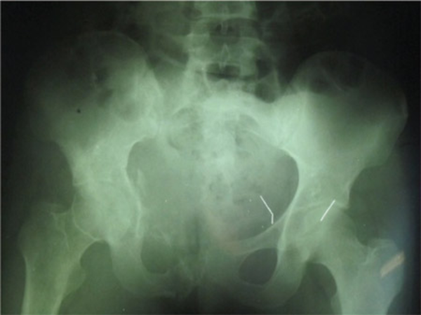 Destructive Area of Pelvic Bone Especially In Left Side of Hemipelvis