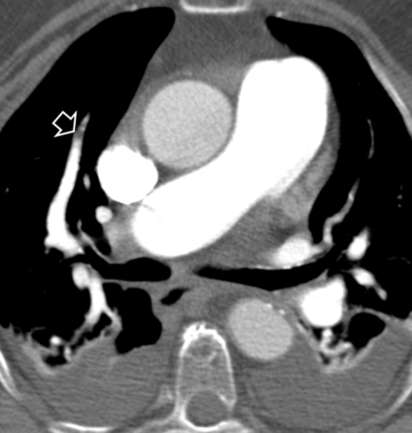 Split-bolus single-pass 64-slice CT shows flow-related artifact in the right segmentary pulmonary artery (arrow).