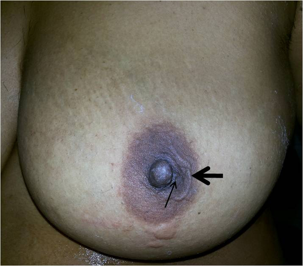 A 30-year-old female with palpable subcutaneous nodular swelling in the areola from 2 months ago. Local examination shows a nodular swelling (line arrow) with adjacent cord like swelling (solid arrow) in the areolar region of the left breast.