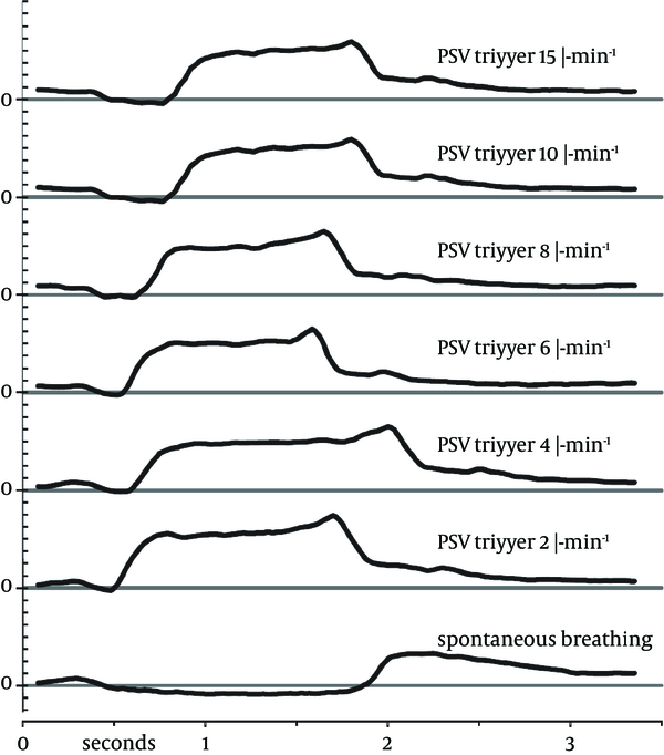 Pressure waveforms of a single patient with different trigger settings (Top to bottom: 15, 10, 8, 6, 4, 2 L/minute and no PSV). Horizontal lines indicate 0 mbar for each waveform; ticks on vertical axis represent 1 mbar increments.