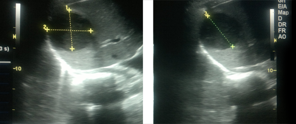 Ultrasound Image of Liver Abscess