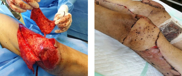 A, Lateral distal thigh island flap for left knee; B, left knee after surgery.