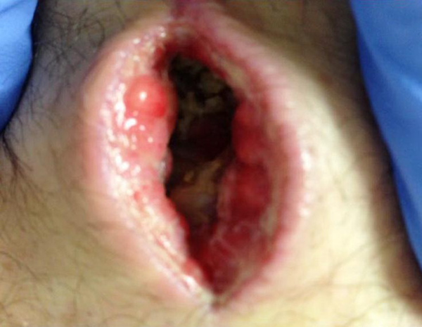 Paraspinal Open Wound 10 Days After Surgical Removal of IDDS System With Clear Discharge - CSF