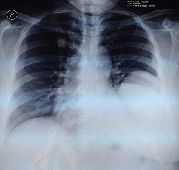Chest Radiography on Admission