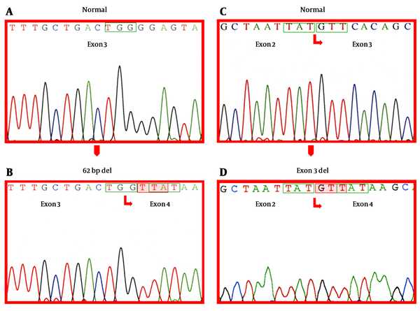 Electropherograms (ABI PRISM 3100 Genetic Analyzer®) of A, Canonical exon 3 sequence; B, Exon 3 and 4 boundary sequence resulting from the splicing of the last 62 nucleotides of exon 3; C, Canonical exon 2 and 3 boundary sequence; D, Exon 2 and 4 boundary sequence resulting from the deletion of the entire exon 3. In boxes wildtype codons; Shadowed-newly formed codons resulting from the deletion, leading to translational frameshifting and premature termination.