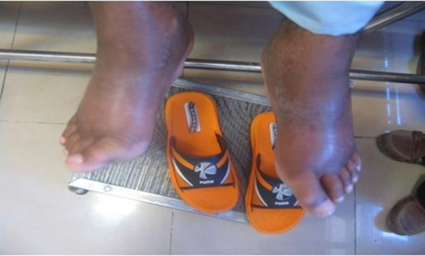 Non-pitting Edema in Extremities