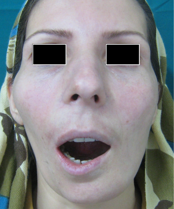 Patient at the Fourteenth Month of Follow-up From the Ti-Mesh Reconstruction