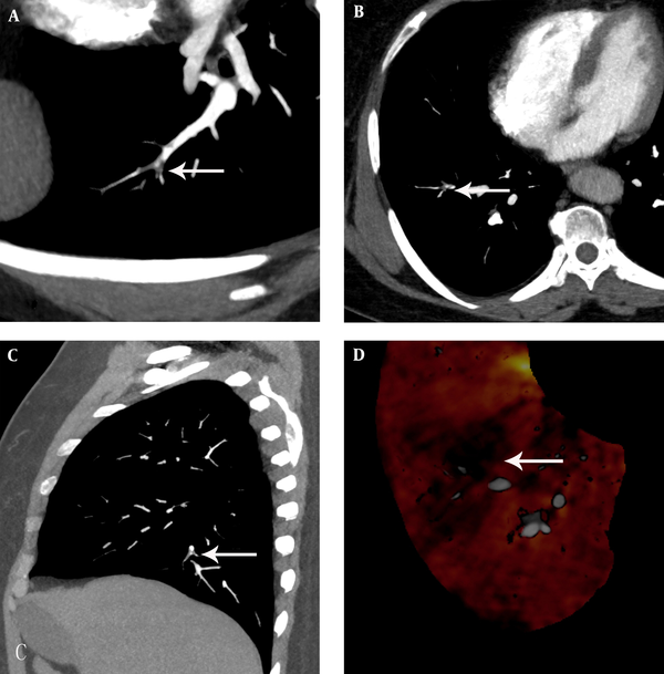 A 68-year-old man with chest distress, chest pain for one week aggravated for one day. A, The pulmonary embolism detection software image showed an irregular filling defect which rode across the arterial bifurcation and luminal narrowing at the lateral basal segment artery of the lower lobe of the right lung. B, C, The computerized tomography pulmonary angiography image found an irregular filling defect which rode across the arterial bifurcation and luminal narrowing at the lateral basal segment artery of the lower lobe of the right lung. D, The dual-energy pulmonary perfusion imaging image revealed mild pulmonary sparse perfusion, partly obvious sparse perfusion and significant sparse portion at the lateral basal segment of the lower lobe of the right lung.