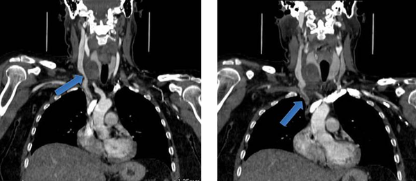 A, B, CT coronal projection shows the right thyroid nodule (arrow in A) and the inflammatory process entering the jugular region (arrow in B) adjacent to the right brachiocephalic vein.