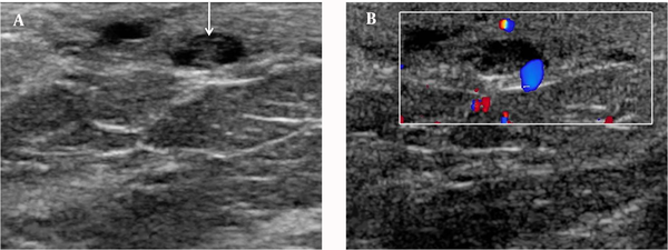 A, Follow-up ultrasound showed prominence of lymphatic channels with linear echoes (arrow), and loss of twirling movement (dead worms). B, the color motion artifact was not seen.