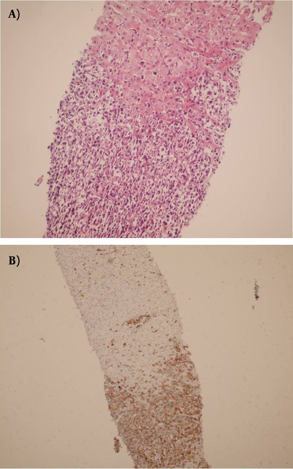 Sections From Allografted Biopsy Shows Dense Infiltration of Lymphoma Cells, Diagnosed as PTLD (A and B) (a: H&EX250, b:IHC for CD20 )