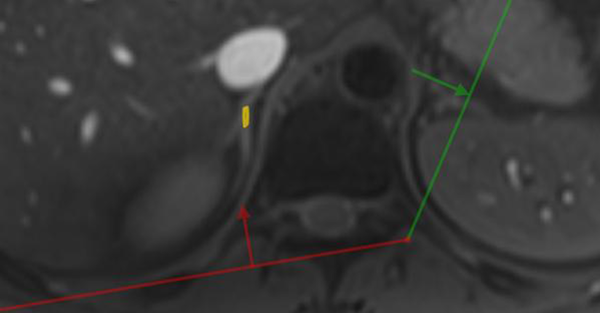 T2* measurement on the medial limb of the adrenal gland with free-hand region of interest (ROI) is shown.