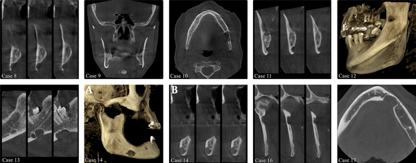 Cross-sectional (case 8, 11, 14b, and 16), and coronal (case 9), axial (case 10, and 17) sections of cone beam computed tomography (CBCT) images demonstrate that the lesion is a bone depression of the mandible, and is not a cyst cavity. Cross-sectional (case 13) CBCT images demonstrate that SBC is bilobed. Three dimension reconstructed CBCT images demonstrate Stafne bone cavity (SBC) on the lingual (case 12) and buccal (case 14) surface of the mandible.