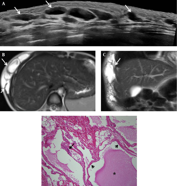 A 4-year-old boy with a cystic lymphangioma of the abdominal wall. A, Abdominal ultrasonography image shows a multiloculated cystic mass (long arrow) in the subcutaneous layer of the right upper abdominal wall. B, T2-weighted magnetic resonance axial image of the abdomen shows a multiloculated cystic lesion (long arrow) in the subcutaneous layer of the right anterolateral trunk and intramuscular extension (short arrow). C, Coronal image shows that the multiloculated cystic mass (long arrow) extends into the right lower chest wall; D, Photomicrograph of the excised specimen shows dilated lymphatic spaces filled with homogeneous eosinophilic and proteinaceous material (asterisk), and lined by a flattened layer of endothelial cells (short arrows); The walls of the cyst show scattered lymphoid cells (long arrow) (hematoxylin and eosin staining, × 100).