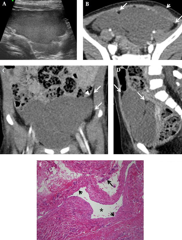 A one-year-old girl with cystic lymphangioma of the abdominal wall; A, Abdominal ultrasonography image shows a lobulated cystic tumor in the left lower abdomen. B, Contrast-enhanced abdominopelvic computed tomography axial image shows a lobulated, homogeneous mass in the pelvic cavity, which extends to the subcutaneous layer of the left lower abdominal wall, without destruction of the abdominal wall (short arrow). The mass is surrounded by prominent properitoneal fat (long arrows), and it displaces the urinary bladder to the right. C, Elevated properitoneal lining (arrowhead) and prominent properitoneal fat (long arrows) are seen in the coronal view. D, Sagittal image shows that the mass is surrounded by prominent properitoneal fat (long arrows), and it displaces the urinary bladder inferiorly and the small bowel superiorly. E, Photomicrograph of the excised mass shows dilated lymphatic spaces (asterisk) lined by a flattened layer of endothelial cells (short arrows). The walls of the cyst show scattered lymphoid cells (long arrow) (hematoxylin and eosin staining, × 100).