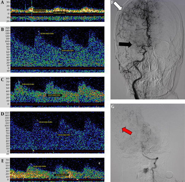 Digital subtraction angiography and transcranial Doppler images of a 61-year-old woman with LMCA occlusion. TCD images indicate the low systolic velocity of the LMCA (A) and the substantially higher systolic velocity of the LACA (B) compared with the RACA (C), as well as the substantially higher systolic velocity of the LPCA (D) and the RPCA (E). Digital subtraction angiography indicates the occlusion of the LMCA (F, black arrow), the connections between the MCA and ACA (F, white arrow), and the connections between the middle and posterior cerebral arteries (G, red arrow).