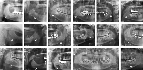 Cropped panoramic radiographs (case 1-6, and 8-17) and lateral oblique mandible projection (case 7) demonstrates various size, location, and types of the Stafne bone cavity (SBC) (arrows).