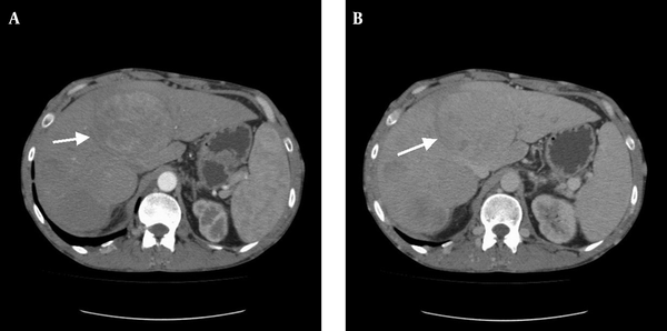 A, Large regenerative nodule of the liver (the largest one, with a diameter of 9 × 8 cm, has settled in segment 4A-4B); B, CT imaging of the mass in venous phase (Case 3).