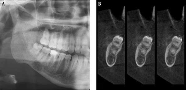 A, Panoramic radiograph demonstrates diffuse radiolucency similar to Stafne bone cavity (SBC) that is located in the right posterior mandible, below the inferior alveolar canal. B, Cross-sectional CBCT images demonstrate that the lesion shown in panoramic radiography (A) is a focal osteoporotic bone marrow defect located in the middle of the mandible which is a radiographic term indicating the presence of focal radiolucencies in areas where hematopoiesis is normally seen within the cancellous bone of the jaws.